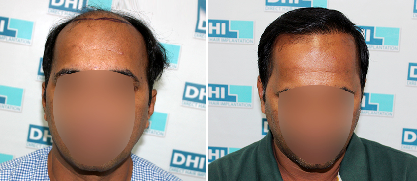 DHI before & after hair transplant results